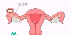 试管宫外孕3大应对方法一览，多久处理最合适要知晓