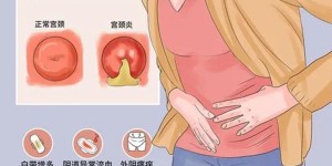 宫颈糜烂是什么症状？宫颈糜烂要如何预防？