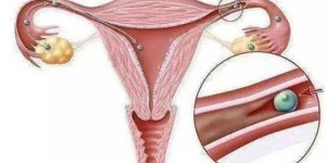 输卵管结核怎么确诊能做试管生育吗？